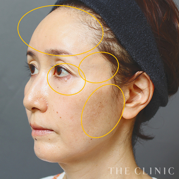 額のシワ・目の下のクマ・こめかみ・こけた頬のSRF注入(顔の脂肪注入)（53歳女性）の術後写真