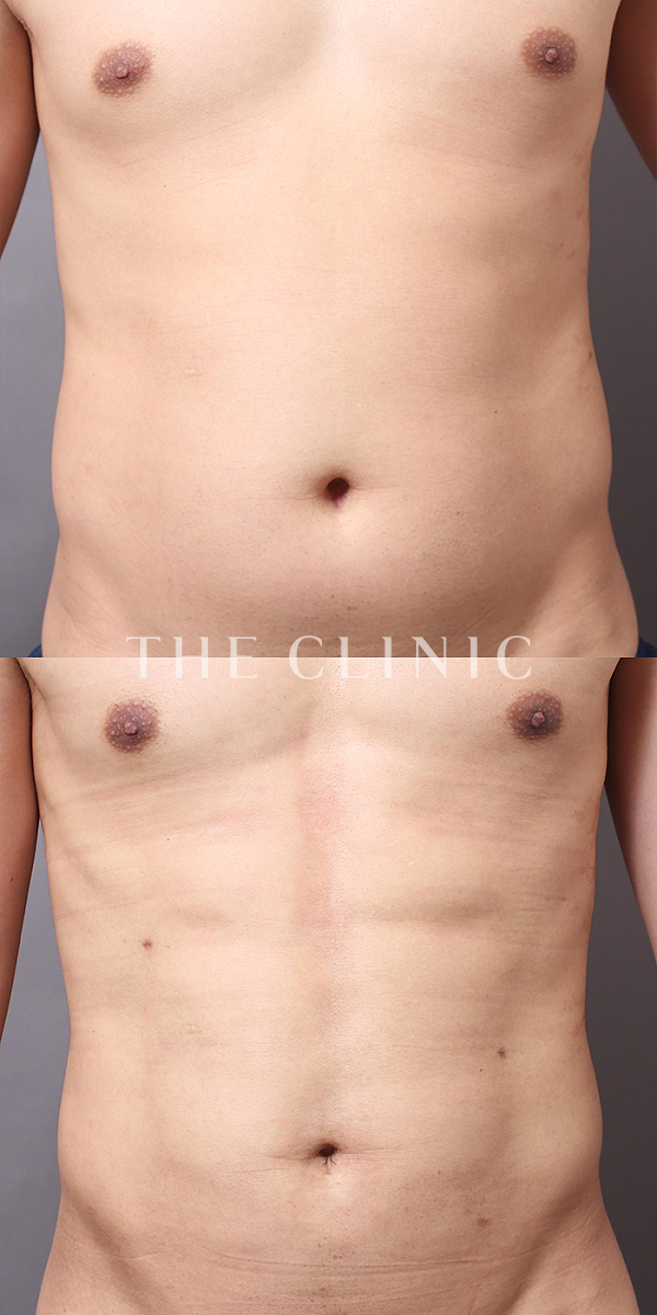 SIX PACK ６つに割れた腹筋のベイザー4D(男性のシックスパック脂肪吸引)（32歳男性）の術前・術後写真
