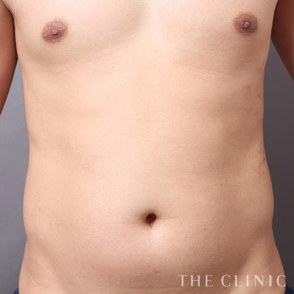 SIX PACK ６つに割れた腹筋のベイザー4D(男性のシックスパック脂肪吸引)（32歳男性）の術前写真