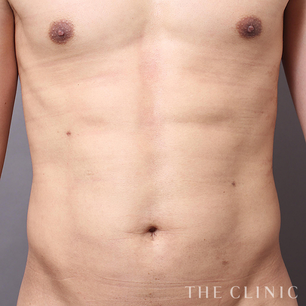 SIX PACK ６つに割れた腹筋のベイザー4D(男性のシックスパック脂肪吸引)（32歳男性）の術後写真