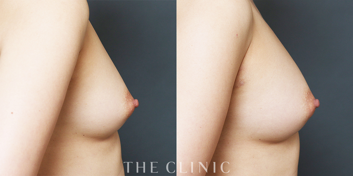 コンデンスリッチ豊胸の術前／術後