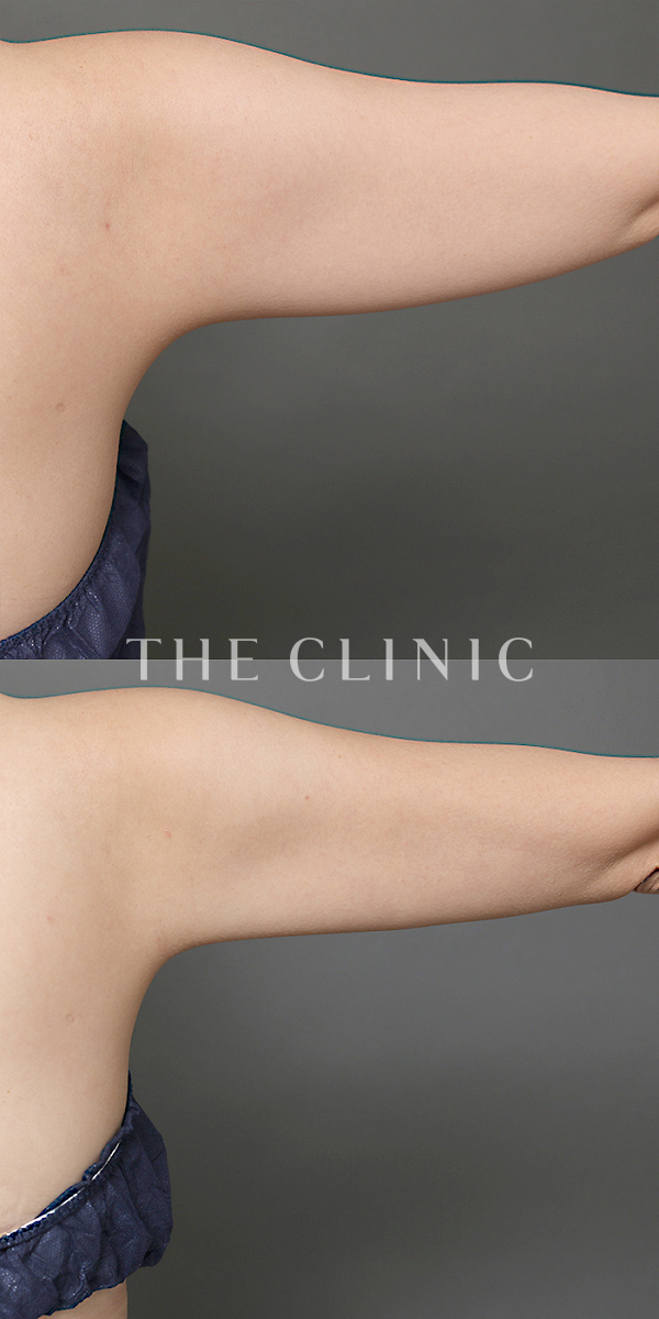 二の腕・腕の付け根のベイザー脂肪吸引（43歳女性）の術前・術後写真