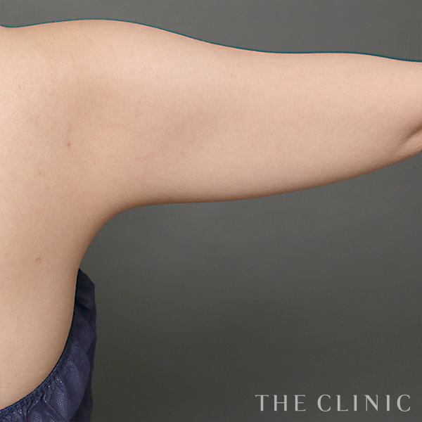 二の腕・腕の付け根のベイザー脂肪吸引（43歳女性）の術前写真