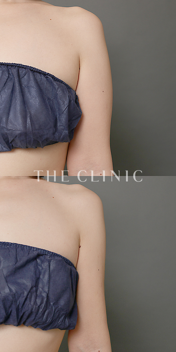 二の腕・腕の付け根のベイザー脂肪吸引（38歳女性）の術前・術後写真