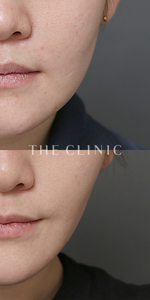 頰／顎のベイザー脂肪吸引（31歳女性）の術前・術後写真