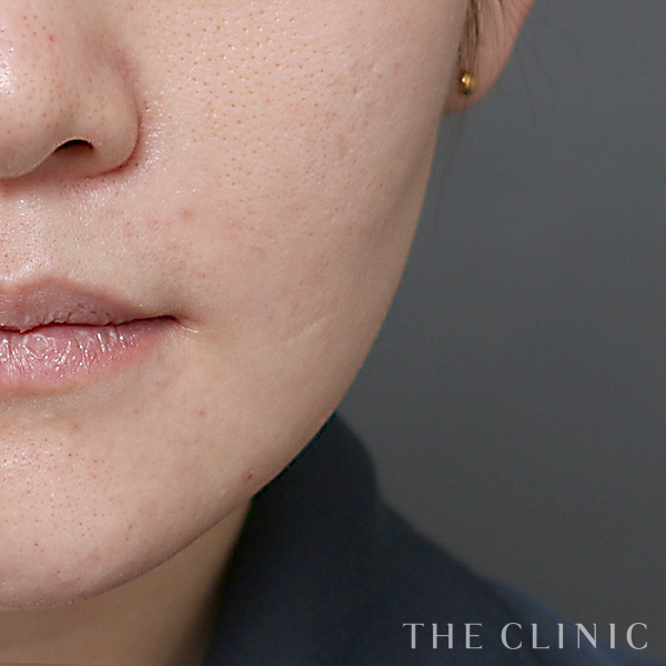 頰／顎のベイザー脂肪吸引（31歳女性）の術前写真