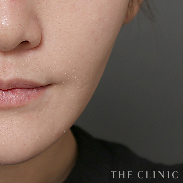 頰／顎のベイザー脂肪吸引（31歳女性）の術後写真