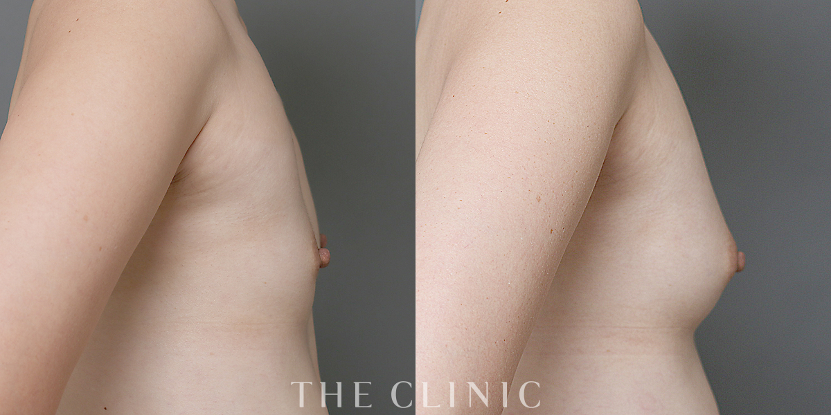 コンデンスリッチ豊胸の術前／術後