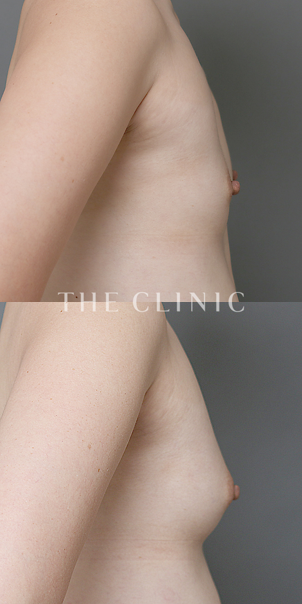 ボリュームアップのコンデンスリッチ豊胸（36歳女性）の術前・術後写真