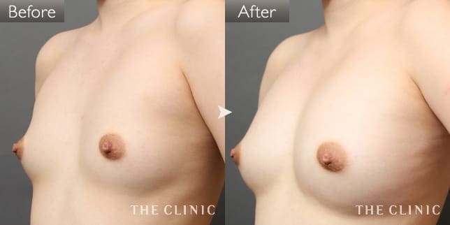 ボリュームアップ（女性／22歳）