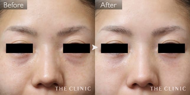 目の上のくぼみ(女性/31歳)