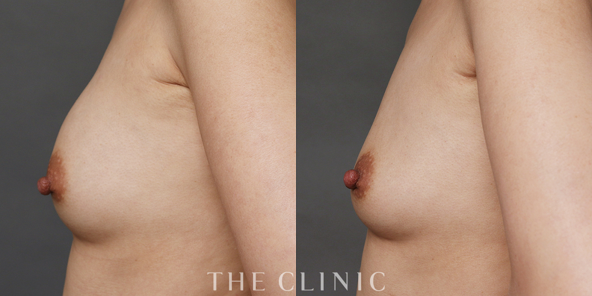 豊胸シリコンバッグ除去の術前／術後