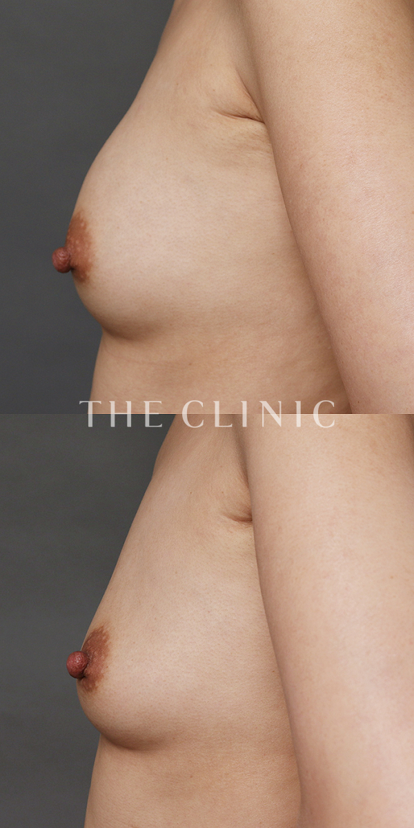 シリコンバッグ抜去の豊胸シリコンバッグ除去（48歳女性）の術前・術後写真