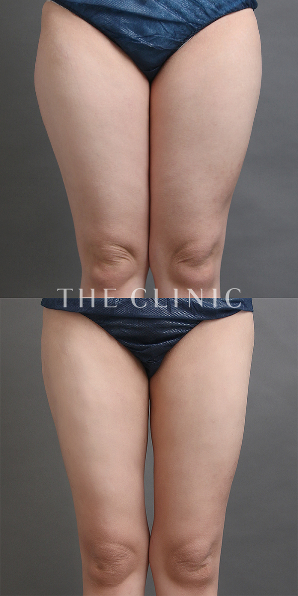 太もも・膝のベイザー脂肪吸引（26歳女性）の術前・術後写真