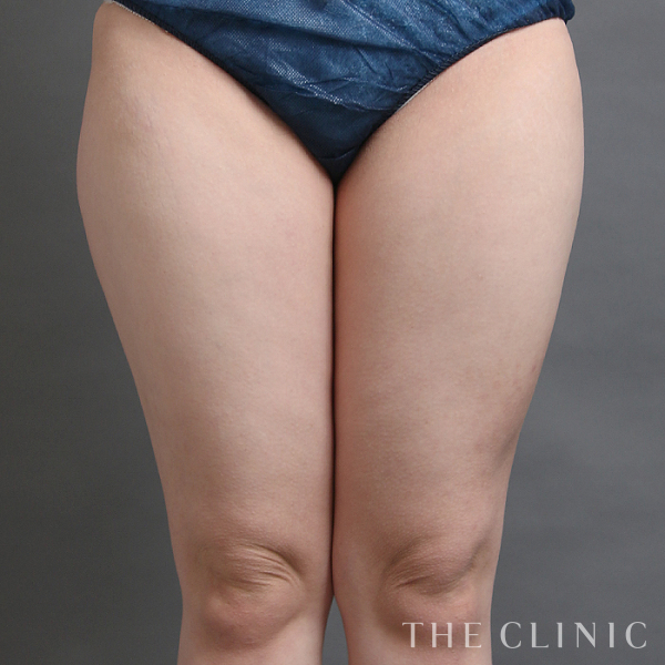 太もも・膝のベイザー脂肪吸引（26歳女性）の術前写真