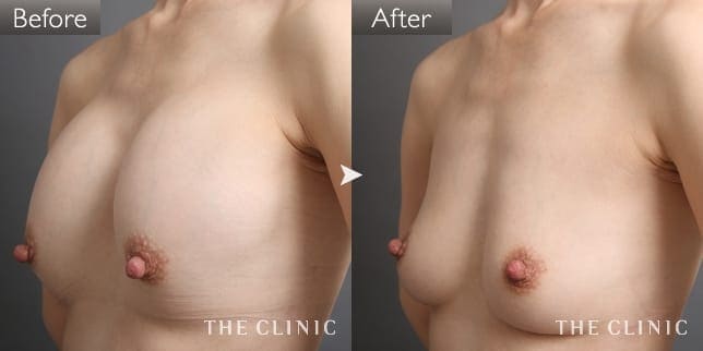 シリコンバッグ抜去（女性／42歳）