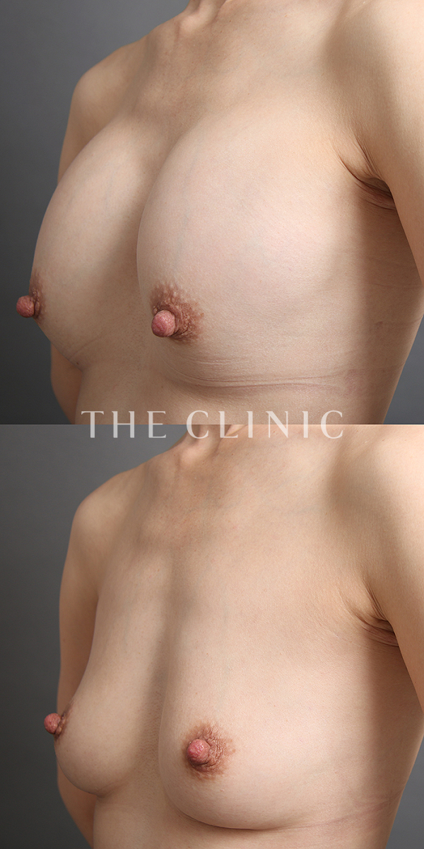 シリコンバッグ抜去の豊胸シリコンバッグ除去（42歳女性）の術前・術後写真