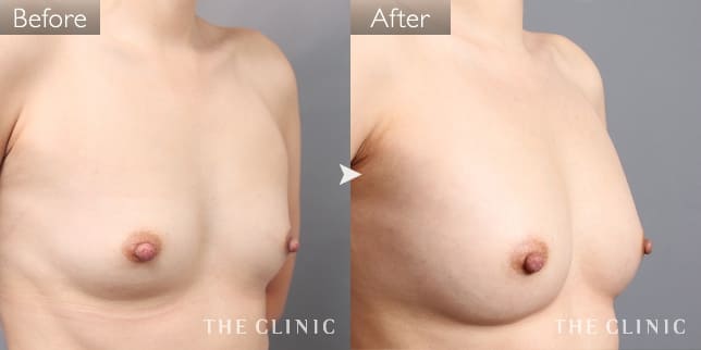 ボリュームアップ(女性/28歳)