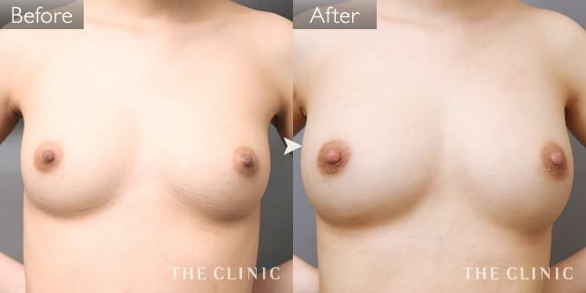 ボリュームアップ（女性／22歳）