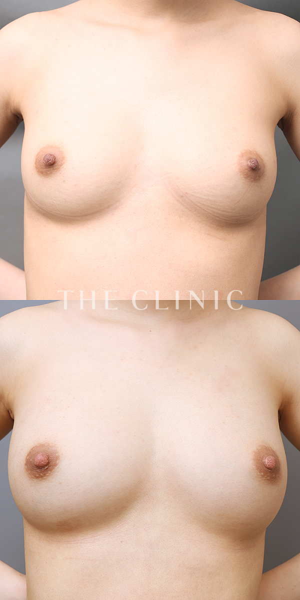 ボリュームアップのコンデンスビブラ豊胸（22歳女性）の術前・術後写真