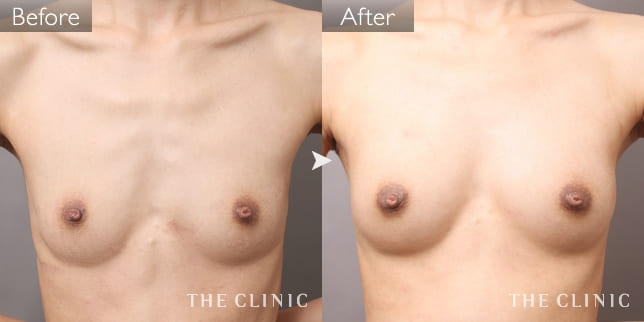 ボリュームアップ（女性／25歳）