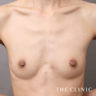 【THE CLINIC 症例画像】No.940_1_ボリュームアップ_コンデンスビブラ豊胸(執刀医:村田 八千穂)