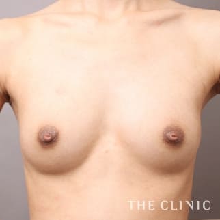 【THE CLINIC 症例画像】No.940_2_ボリュームアップ_コンデンスビブラ豊胸(執刀医：村田 八千穂)