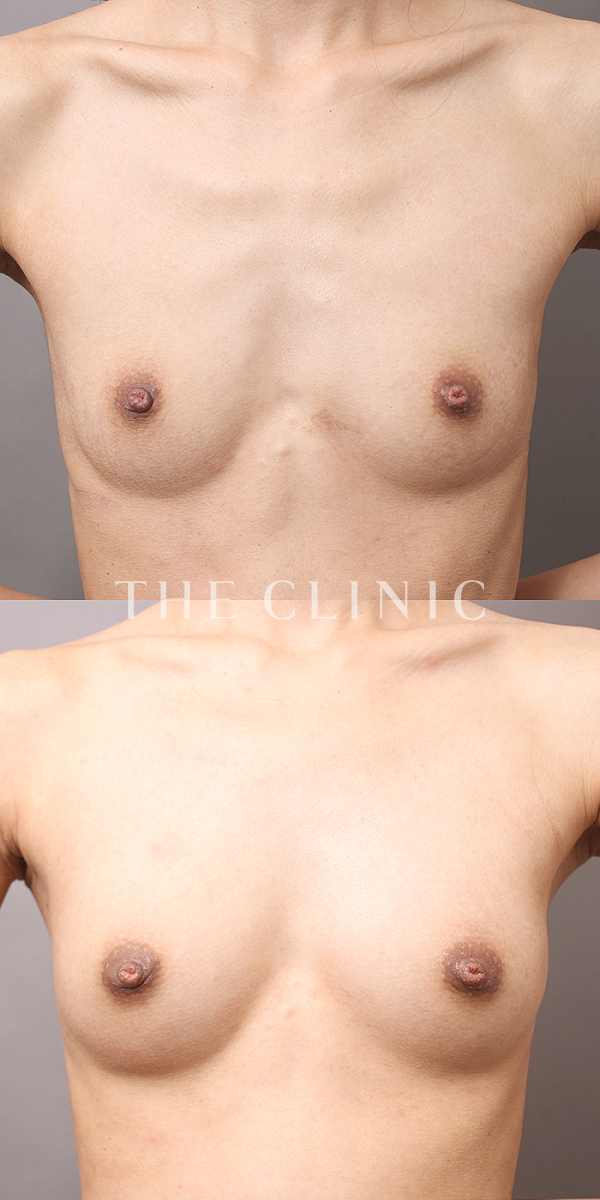 ボリュームアップのコンデンスビブラ豊胸（25歳女性）の術前・術後写真