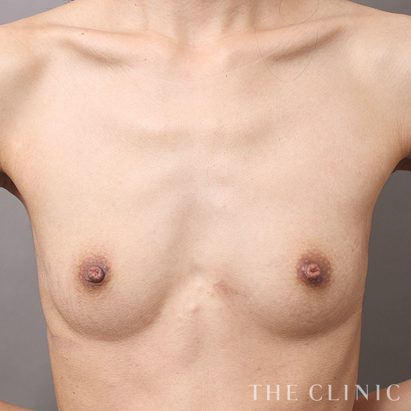 ボリュームアップのコンデンスビブラ豊胸（25歳女性）の術前写真