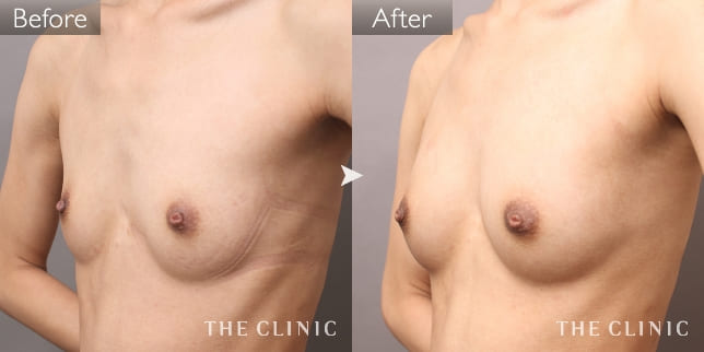 ボリュームアップ(女性/25歳)