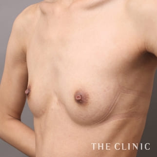 【THE CLINIC 症例画像】No.941_1_ボリュームアップ_コンデンスビブラ豊胸(執刀医：村田 八千穂)
