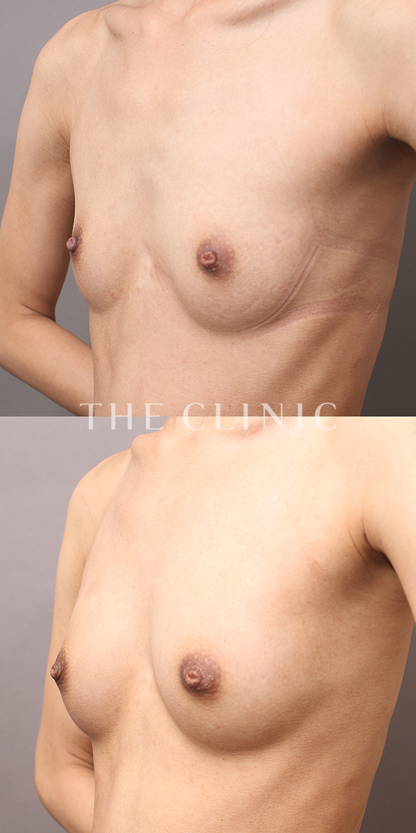 ボリュームアップのコンデンスビブラ豊胸（25歳女性）の術前・術後写真