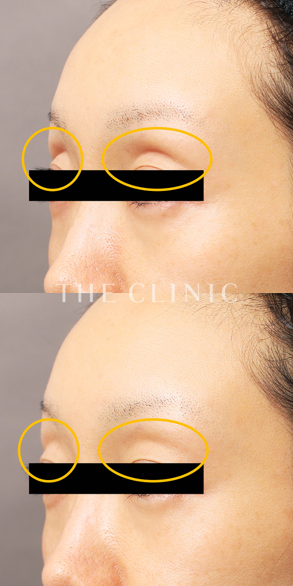 目の上のくぼみのマイクロCRF注入(顔の脂肪注入)（38歳女性）の術前・術後写真