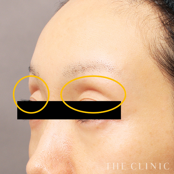 目の上のくぼみのマイクロCRF注入(顔の脂肪注入)（38歳女性）の術前写真