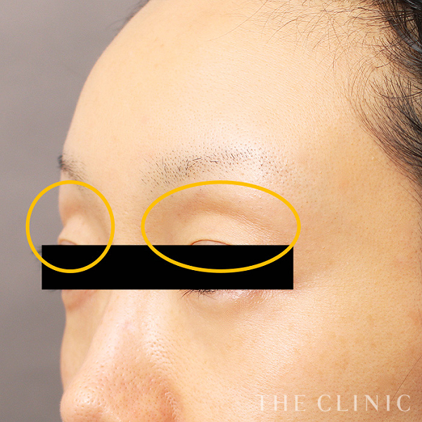 目の上のくぼみのマイクロCRF注入(顔の脂肪注入)（38歳女性）の術後写真