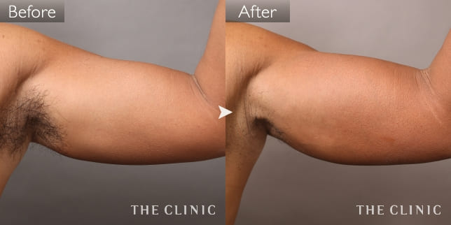 上腕のデザイン(男性/55歳)