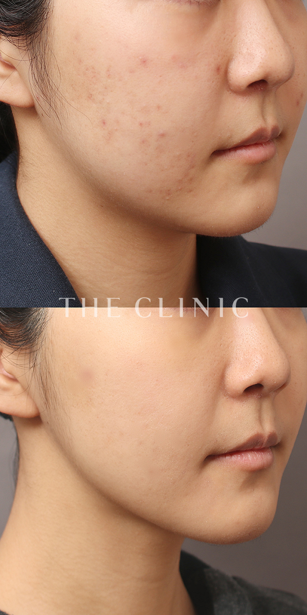 頰／顎のベイザー脂肪吸引（23歳女性）の術前・術後写真