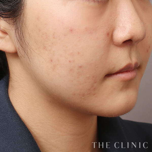 頰／顎のベイザー脂肪吸引（23歳女性）の術前写真