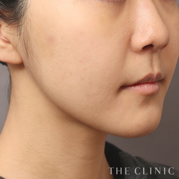 頰／顎のベイザー脂肪吸引（23歳女性）の術後写真