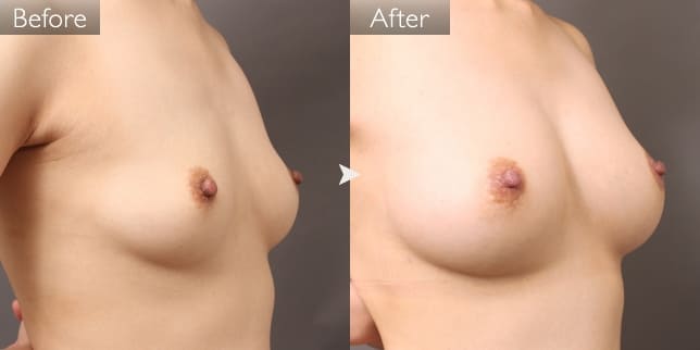 授乳後のたるみ（女性／40歳）