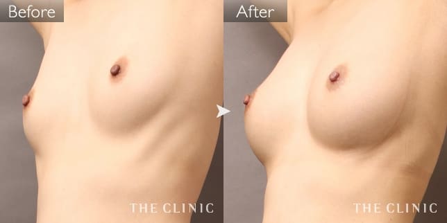 ボリュームアップ（女性／40歳）