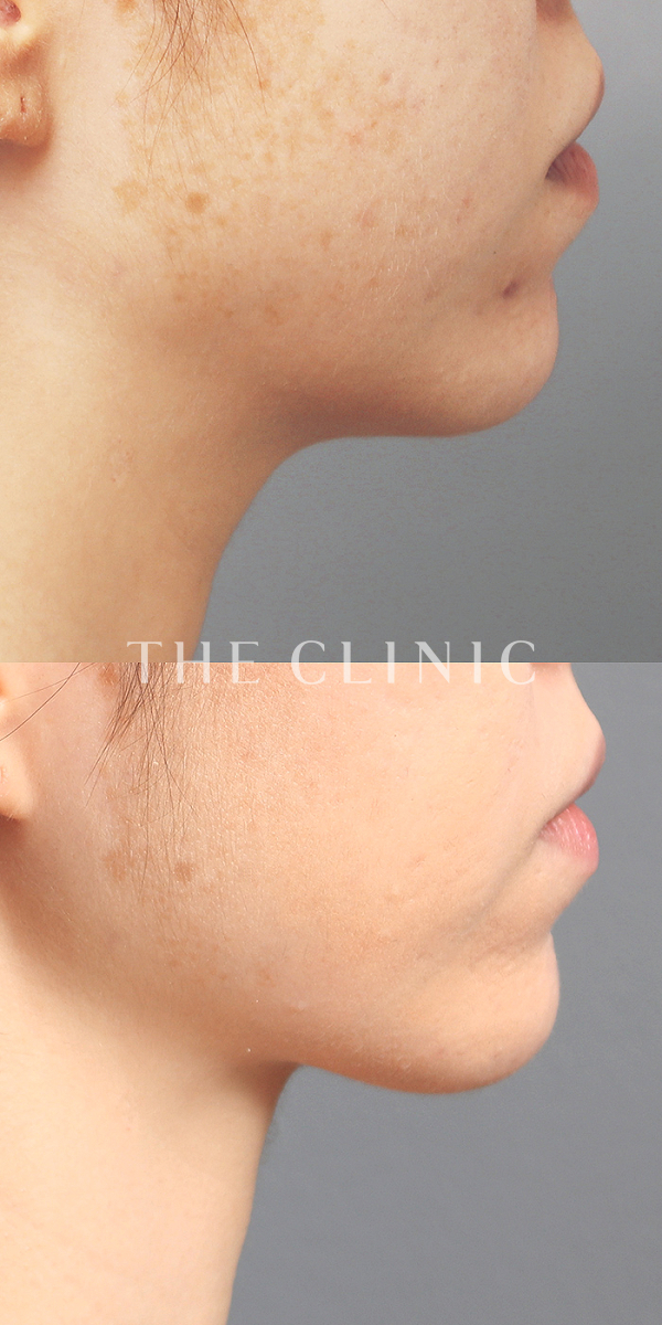 頰／顎のベイザー脂肪吸引（30歳女性）の術前・術後写真