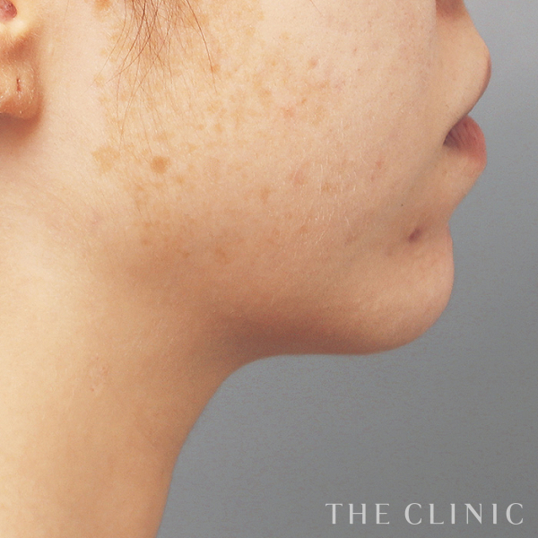 頰／顎のベイザー脂肪吸引（30歳女性）の術前写真