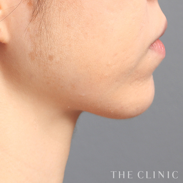 頰／顎のベイザー脂肪吸引（30歳女性）の術後写真