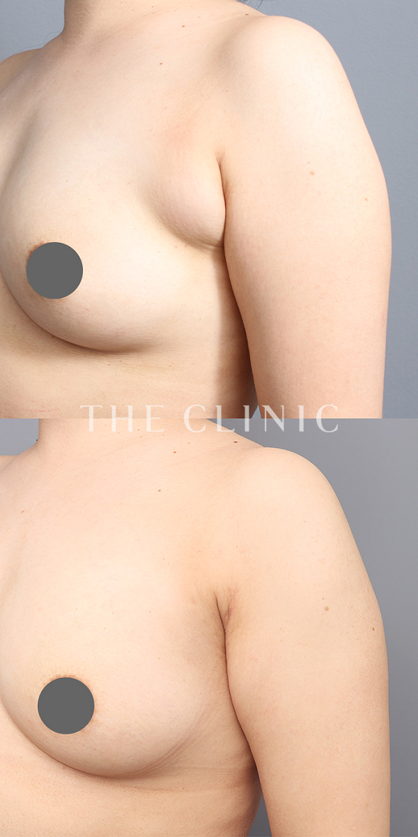 腕の付け根のベイザー脂肪吸引（38歳女性）の術前・術後写真