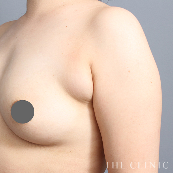 腕の付け根のベイザー脂肪吸引（38歳女性）の術前写真