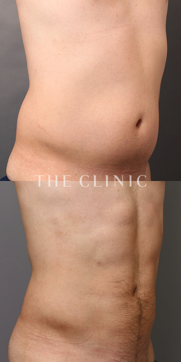 腰・ウエスト・SIX PACK ６つに割れた腹筋のベイザー4D(男性のシックスパック脂肪吸引)（31歳男性）の術前・術後写真