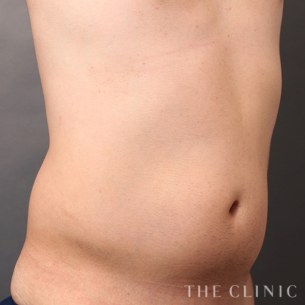 腰・ウエスト・SIX PACK ６つに割れた腹筋のベイザー4D(男性のシックスパック脂肪吸引)（31歳男性）の術前写真