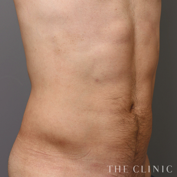 腰・ウエスト・SIX PACK ６つに割れた腹筋のベイザー4D(男性のシックスパック脂肪吸引)（31歳男性）の術後写真