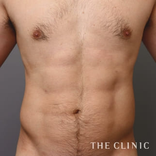 【THE CLINIC 症例画像】No.952_2_胸部のデザイン_ベイザー4D(男性のシックスパック脂肪吸引)(執刀医:大橋 昌敬)
